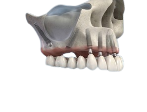 BSS sinus bypass: the alternative to zygomatic implants