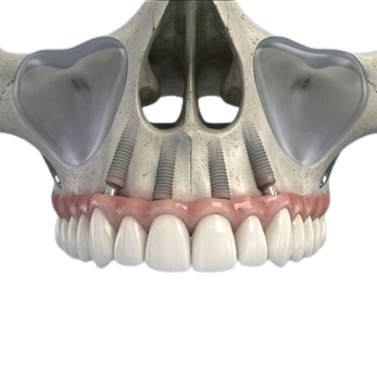 Bone loss associated with a removable denture