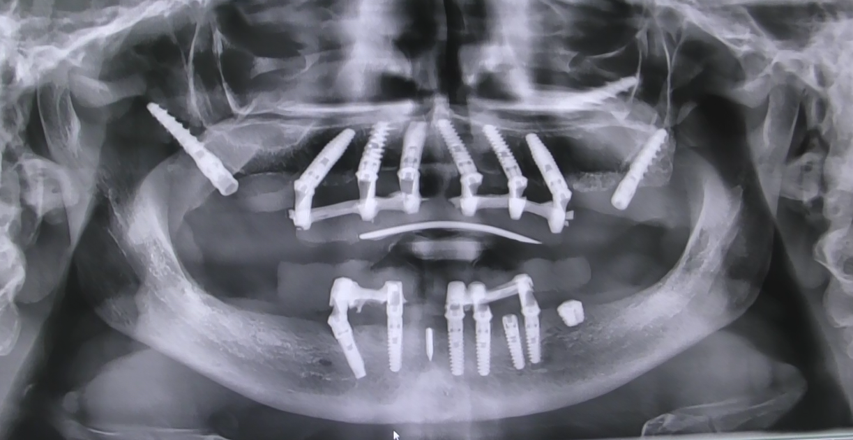 Real panoramic: full molar support restored