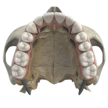 All-on-Full implant positioning scheme: posterior pterygoid pillars (18, 28) and retrocanine fossae (15, 25) with anchorage in the palate and sphenoid